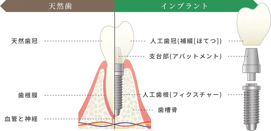 インプラントのイラスト